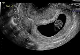 Image result for First Trimester Ultrasound