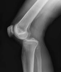 The journal of musculoskeletal medicine. Knee Dislocation Wikipedia