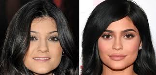 Kylie jenner's lips before and after. Kylie Jenner Talks Plastic Surgery What Do Her Before And After Photos Show The Inquisitr