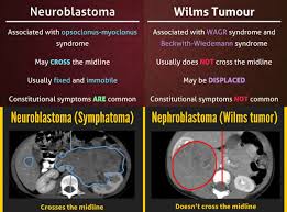 Image result for Nephroblastoma