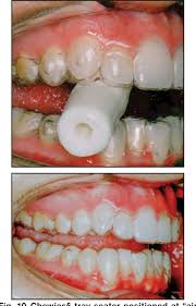 Gap teeth can create pockets between your teeth and gums where food can get stuck. Figure 10 From Creative Adjuncts For Clear Aligners Part 2 Intrusion Rotation And Extrusion Semantic Scholar