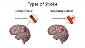 Just as strokes have many effects, they also have many causes. Athersys Inc Clinical Trials Ischemic Stroke