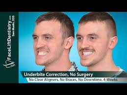 See full list on faceliftdentistry.com Underbite Correction Without Surgery No Braces No Aligners