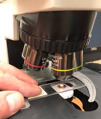 Bone marrow aspiration uses a hollow needle to remove a small sample (about 1 ml) of bone marrow for examination under a microscope. Histology Wikipedia
