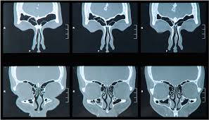 Image result for Rhinosinusitis