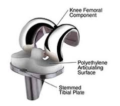 Knee Replacement Surgery: Procedure, Types and Risks | HSS