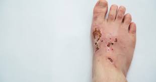 Image result for dermatitis contacta allergica