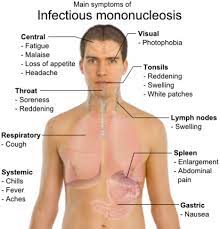 Epstein Barr Virus Infectious Mononucleosis