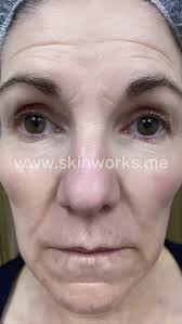 Introducing Fusion Plasma, the next-generation treatment redefining skin  rejuvenation. Say farewell to harsh ablative lasers and uncomfortable  peels—Fusion Plasma delivers a powerful transformation without the stress  or downtime. ✨ Gentle, non ...