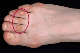 A lump is a bump, nodule, tumor, or localized area of swelling that can occur anywhere on your body. Corns And Calluses Nhs