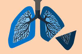 Sclc is the most aggressive kind of lung cancer. Life After Lobectomy 6 Steps To A Smooth Recovery After Lung Cancer Surgery Health Essentials From Cleveland Clinic