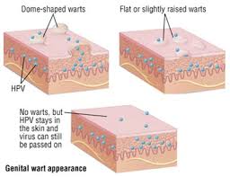 Image result for genital warts