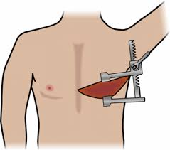 Emergency Department Thoracotomy in Trauma | Current Surgery Reports