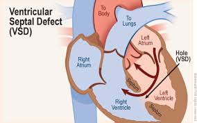 Image result for Ventricular Septal Defect