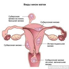 Boli V Spine I Nogah Mogut Ukazyvat Na Miomu
