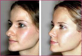 Pin On Liposculpture Before And After