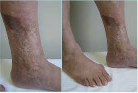 Image result for Lipodermatosclerosis