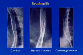 Esophagitis may cause odynophagia and even esophageal hemorrhage, which is usually occult but can be massive. Herpes Simplex Viruses Hsv Images Hiv