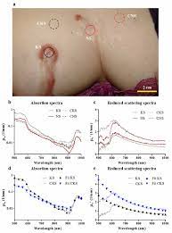 A The Clinical Picture Of A Keloid Patient Containing Keloid Scar Download Scientific Diagram