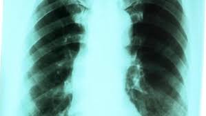 Rezultate imazhesh pÃ«r karcinom pluca