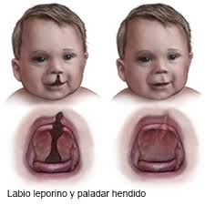 Las hendiduras orofaciales, especialmente el labio hendido, con o sin hendidura de paladar, pueden diagnosticarse durante el embarazo mediante una ecografía de rutina. Labio Leporino Y Paladar Hendido Inpatient Care Care Guide Information En Espanol