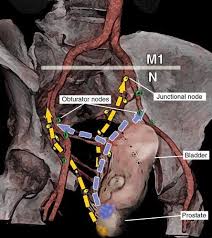 Medically reviewed by christina chun, mph — written by rachel nall, msn, crna on may. Common Pathways Of Metastasis From Prostate Cancer The Obturator Nodes Download Scientific Diagram