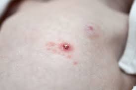 Neonatal herpes simplex virus infections can result in serious morbidity and mortality. What Lies Beneath Hsv Meningitis In The Asymptomatic Infant Archives Of Disease In Childhood