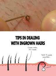 Ingrown hair on the vagina, scrotum, or bikini area may sometimes be confused with sexually transmitted diseases or infections. 9 Ingrown Hair Ideas Ingrown Hair Ingrown Hair Remedies Ingrown Hair Removal