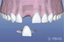 Gigi palsu akrilik paling ekonomis dibandingkan gigi palsu lepasan lainnya. Restorative Shoreline Wa Greg Ganzkow Dds Who Doesn T Want A Perfect Smile Dentist Shoreline Wa