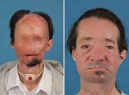 After and before tasting the sour candy, warheads. Imaging Plays Increasingly Critical Role Face Transplantation