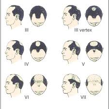 The Norwood Hamilton Scale Of Malepattern Baldness The