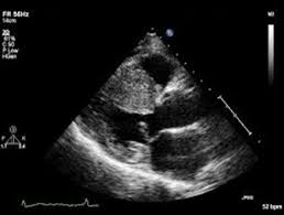 Clinical echocardiography enables you to use echocardiography to its fullest potential in your initial diagnosis, decision making, and clinical management of patients with a wide range of heart diseases. Focus On Echocardiography In Hypertrophic Cardiomyopathy Fourth In Series