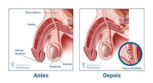 See full list on mayoclinic.org Perguntas E Respostas Sobre A Vasectomia