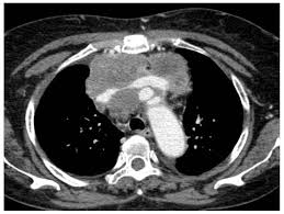 ct (or cat) stands for computed (axial) tomography. Jcm Free Full Text When The Diagnosis Of Mesothelioma Challenges Textbooks And Guidelines Html