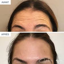 An estimated 10,000 to 100,000 birds die of botulism annually. Supprimer Les Rides Du Front Avec Des Injections De Botox