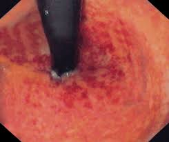 Image result for Proctitis