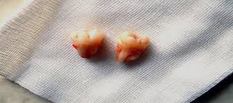 Swelling that hasn't fully subsided by day 7 should be reported to your dentist also. Things Causing More Than Ordinary Pain After Tooth Extraction By Safarian Dental Implants Medium