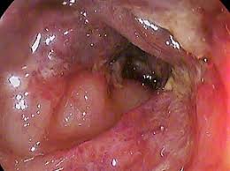 È il quadro dell'occlusione intestinale a localizzazione colica, difficilmente differenziabile da quella da tumore: Diverticolo Intestino Diverticoli Colon Sintomi Diverticoli Dieta Per Diverticoli Cura Diverticolite Dieta Per Diverticolosi Dieta Diverticolosi Diagnosi Infiammazione Diverticolo