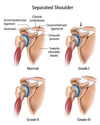 This diagram with labels depicts and explains the details of diagram of a shoulder. 3 Grades Of Separated Shoulder Diagnosis And Treatment