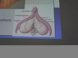 Perempuan sering mencukur bulu kemaluannya karena keberadaanya dianggap kurang estetis. Ini Deretan Langkah Operasi Ganti Kelamin Pria Menjadi Wanita