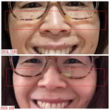 頬のボリュームアップで、メガネの隙間・影がなくなった！ | 美容整形不要！シワとたるみを改善できる顔体操教室