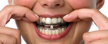Image result for dental appliances for snoring