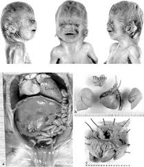 Nager syndrome belongs to a group of disorders collectively known as acrofacial dysostoses or afds. Figure 2 From Tetrasomy 12p Pallister Killian Syndrome Difficulties In Prenatal Diagnosis Semantic Scholar