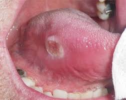 Image result for dental cancer