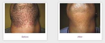 Longer pulse durations enabled the delivery of higher fluences with. Laser Hair Removal Dark Skin Dermatology Care Of Charlotte Dermatology Care Of Charlotte
