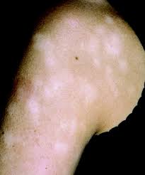 What are the clinical features of pityriasis versicolor? Pityriasis Alba Hypopigmentation Reprinted With Permission From Habif Download Scientific Diagram