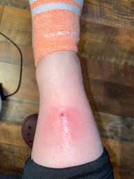 Other common locations of ingrown hairs. Forbidden Pop Full Of Fluid Thought It Was An Ingrown Hair But Dr Thinks It S A Bug Bite Hurts So Bad Anyone See Anything Like This Popping