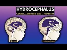 Image result for Hydrocephalus