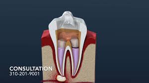 We did not find results for: Recognize The Symptoms Of Failed Root Canal Smile Angels Of Beverly Hills
