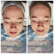 ✨ Dermalogica Brightening Polish Peel Results ✨ This before + after is from  just one pass of the Dermalogica Brightening Peel 🌿✨ Even a single pass  can: ✔️ Gently lift dull, dead skin